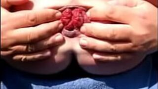 Ass Gape Extreme MonsterExtrem Prolapse Asshole - porn video